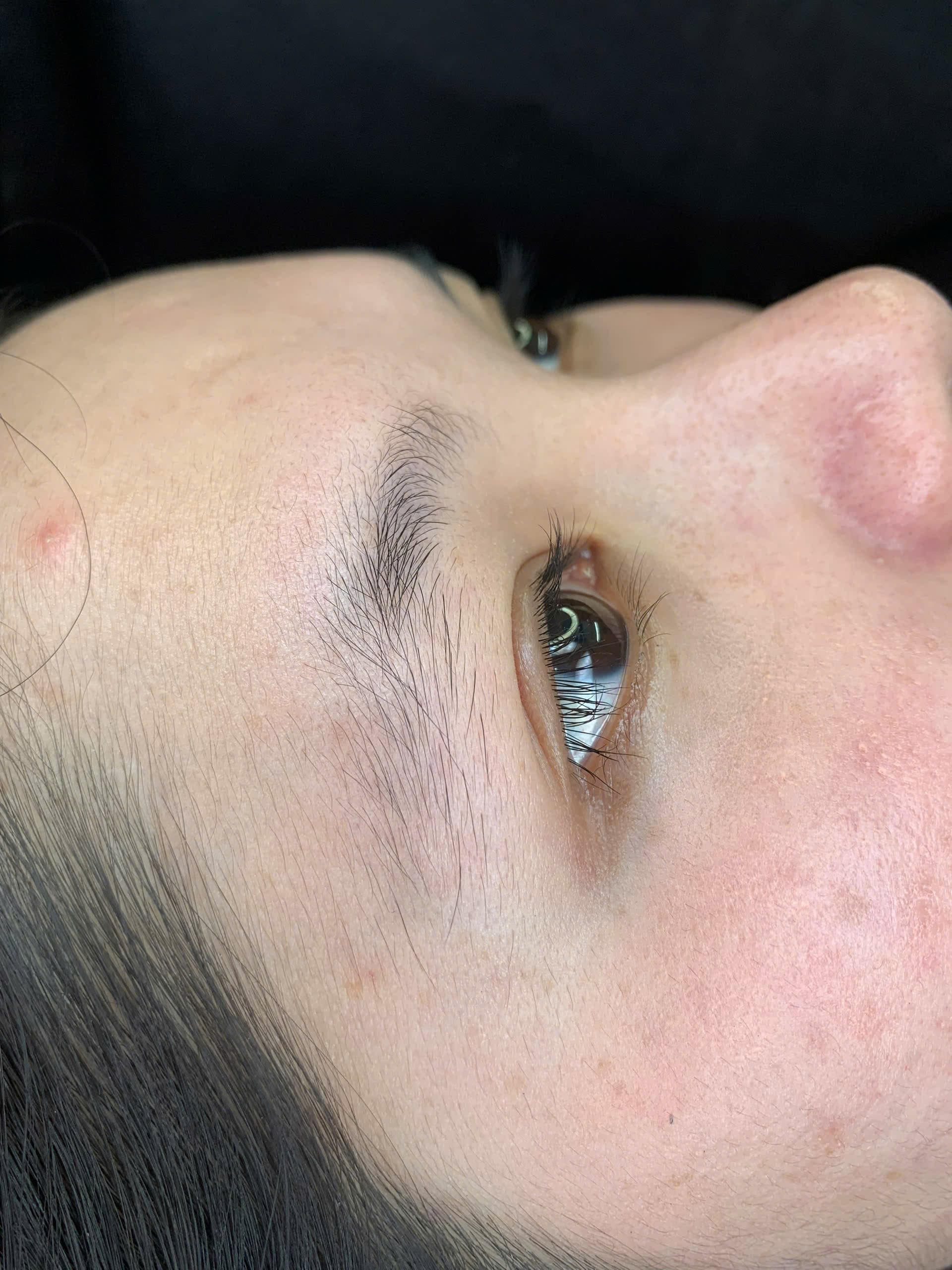 Before · Brow