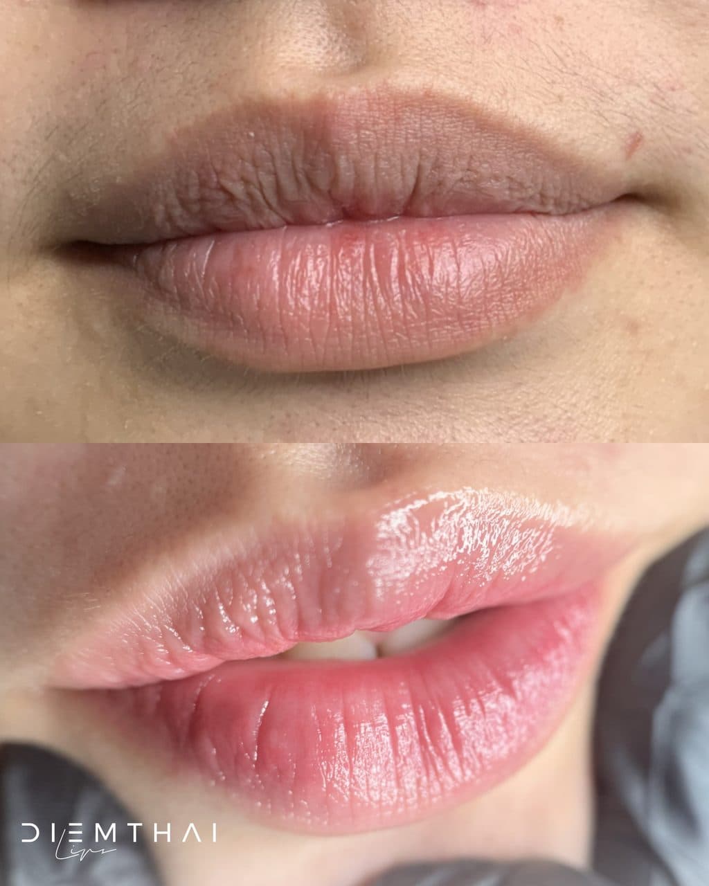 Dark Lip Neutralization