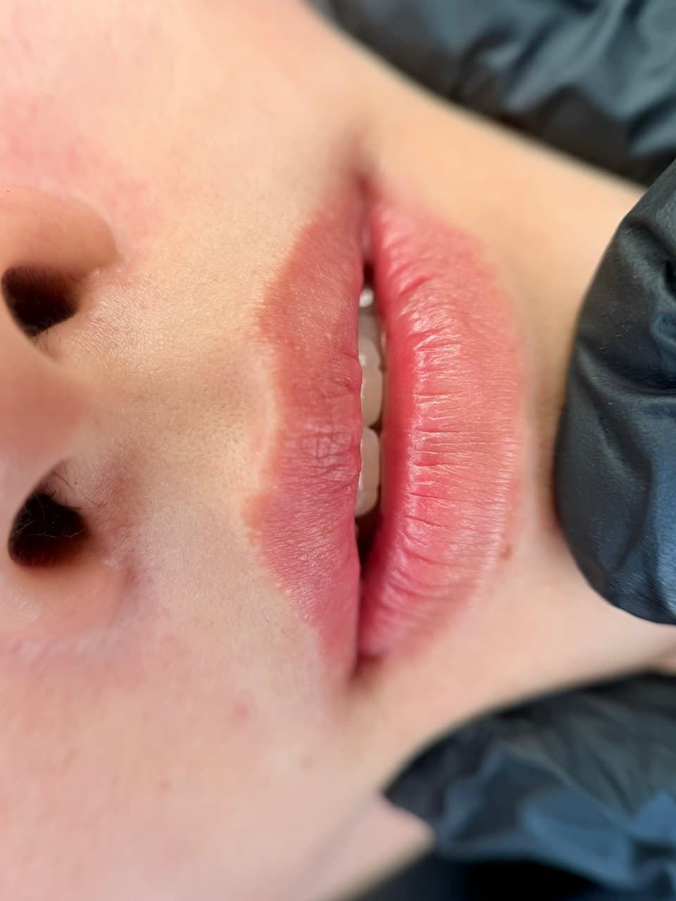 After · Lip