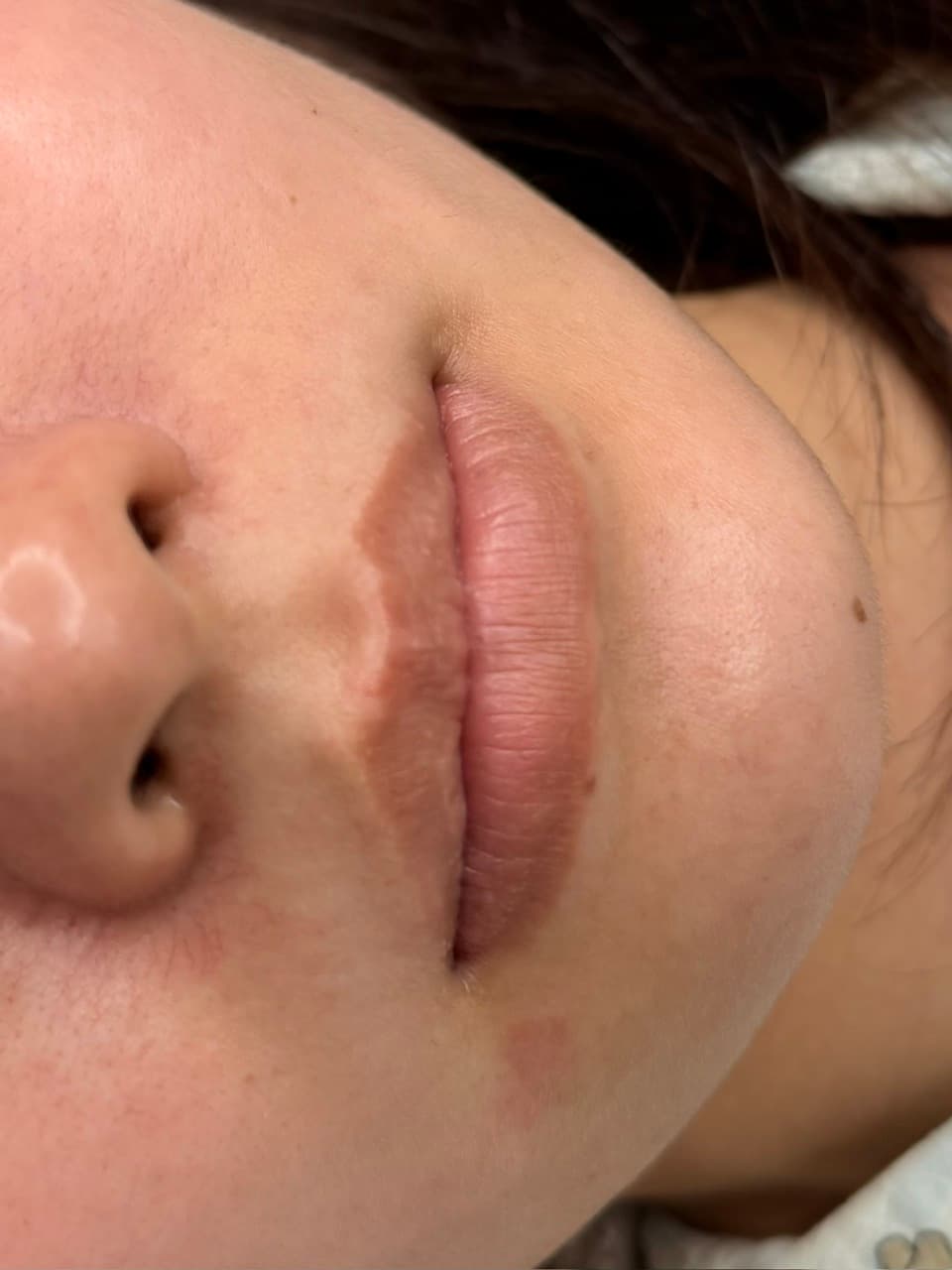 Before · Lip