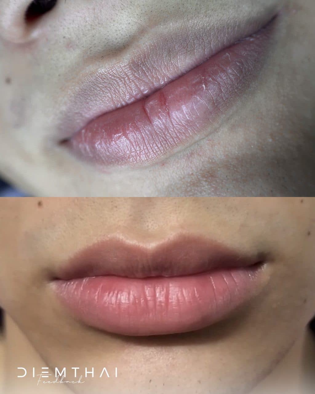 Lip Neutralization