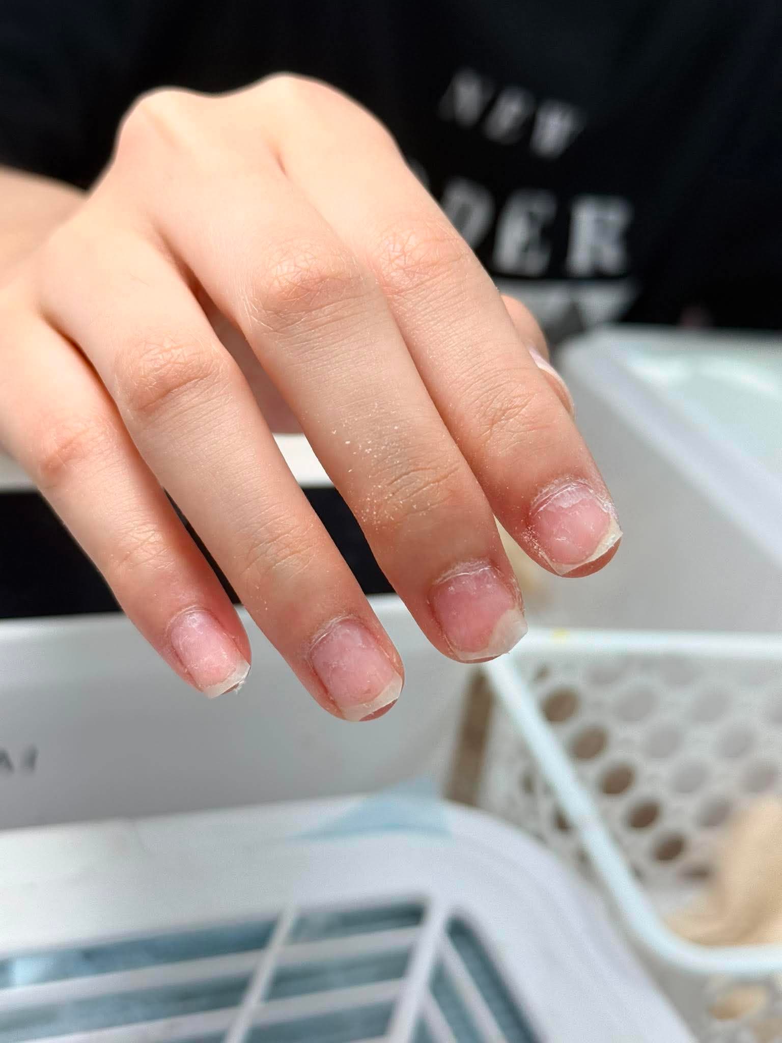 Before · Nail